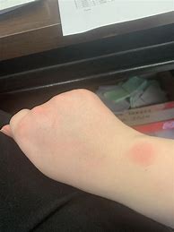 Image result for Fitbit Versa Band Burn On Wrist