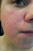 Image result for Face Allergy
