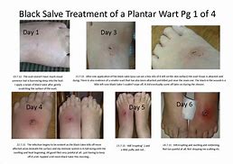 Image result for Plantar Wart Healing Stages