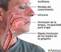 Image result for anafilaxia