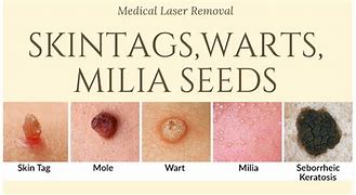 Image result for Abnormal Skin Tags