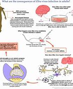 Image result for Zika Virus Adult with Microcephaly