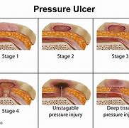 Image result for Pressure Ulcer