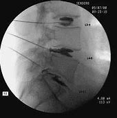 Image result for Lumbar and Cervical Discography