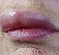 Image result for Food Allergy Rash around Mouth
