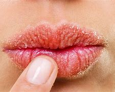 Image result for Allergic Reaction On Lips Treatment