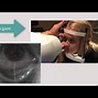 Image result for Scleral Contact Lens