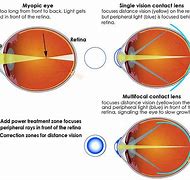 Image result for Lenses for Myopia