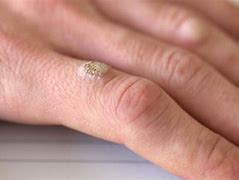 Image result for Medical Wart On Finger Removal