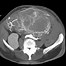 Image result for Necrotic Tumor