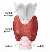 Image result for Thyroid Nodule 2 Cm