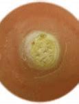 Image result for Sample Genital Warts