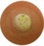 Image result for Genital Wart Identification