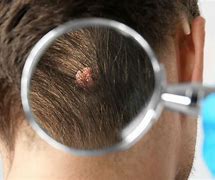 Image result for Scalp Wart Removal