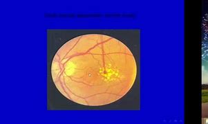 Image result for Cotton-Wool Spots Retina