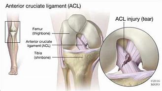 Image result for acl�tere