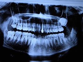 Image result for Unusual Wisdom Teeth