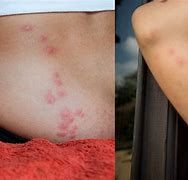 Image result for What Do Bed Bug Bites Look Like Photo On Foot