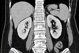 Image result for Normal Kidney MRI