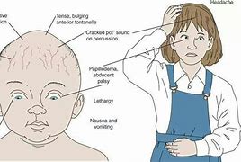 Image result for Hydrocephalus Signs in Adult