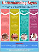 Image result for Pink Eye Treatment