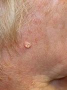 Image result for White Crusty Moles On Skin