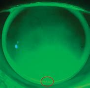 Image result for DACP Toric Lens Markings