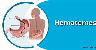 Image result for hematemssis