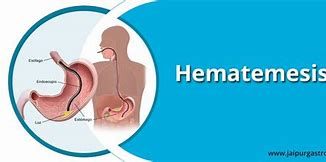 Image result for hematemedis