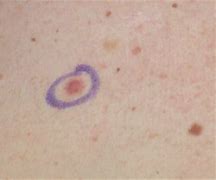 Image result for Pink Mole Skin Cancer