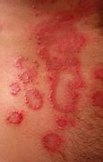 Image result for Molluscum Contagiosum Rash