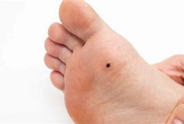 Image result for Flat Wart Removal