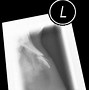Image result for Worst Broken Bone X-ray