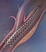 Image result for Carotid Artery Stenting