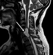 Image result for MRI Cervical Spine Lesions