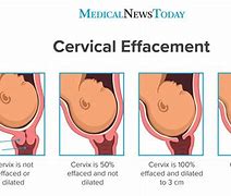 Image result for A Look at a Dilated Cervix