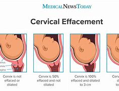 Image result for 8Cm Dilated Cervix