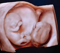 Image result for Fetal Anomalies Ultrasound