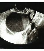 Image result for Big Ovarian Cyst