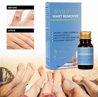 Image result for Best Over the Counter Wart Remover Japanese Brand