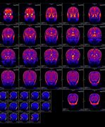 Image result for Bipolar Brain MRI