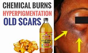 Image result for Chemical Burn Bleach On Skin