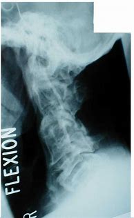 Image result for Congenital Cervical Spine Fusion