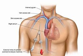 Image result for Tunnelled Central Venous Catheter