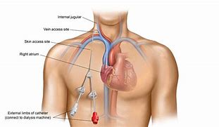 Image result for Central Venous Catheter Placement Procedure