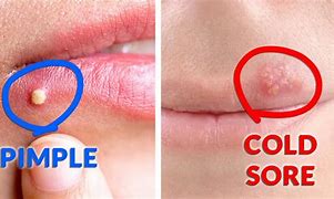 Image result for Cold Sore vs Pimple