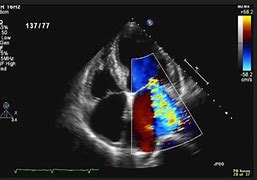 Image result for Heart Ultrasound Echocardiogram