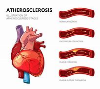 Image result for What Causes Atherosclerosis