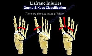 Image result for Lisfranc Fracture Plate