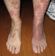 Image result for Nickel Allergy Rash From Metal